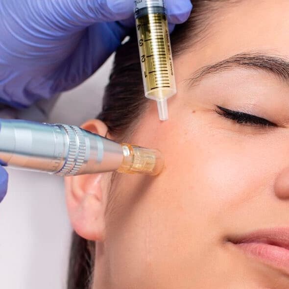 Micronnedeling para acné at STONE AESTHETICS in West columbia, SC